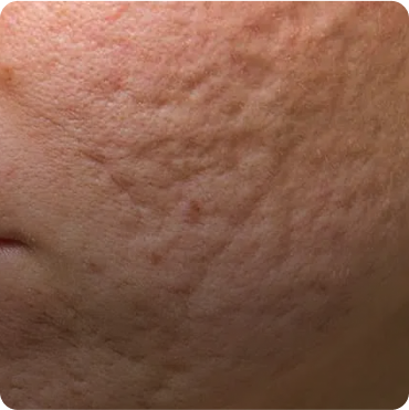 Acne & Scars