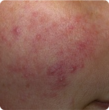 Rosacea